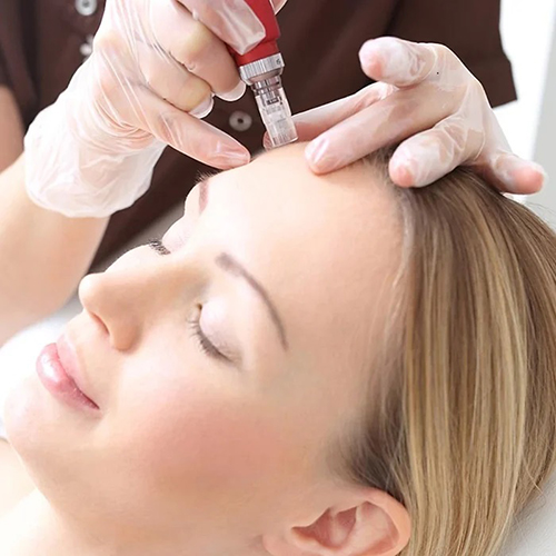 MicroneedlingHolly